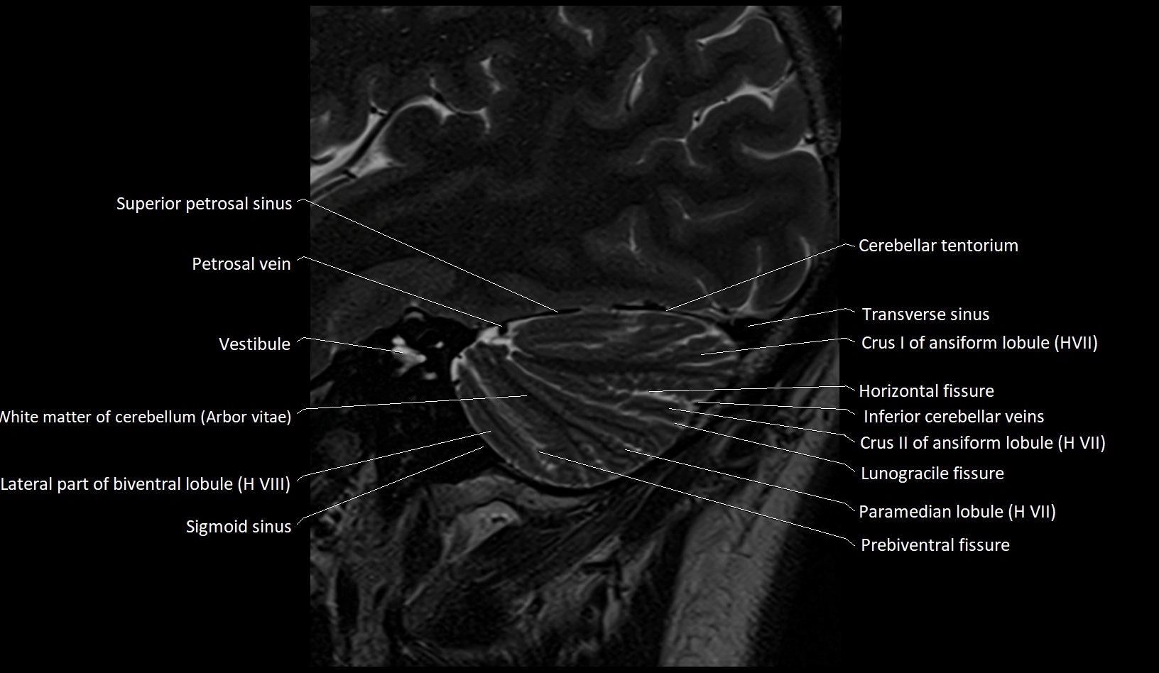 MRI Cerebellar anatomy sagittal High-resolution labelled image 9.webp